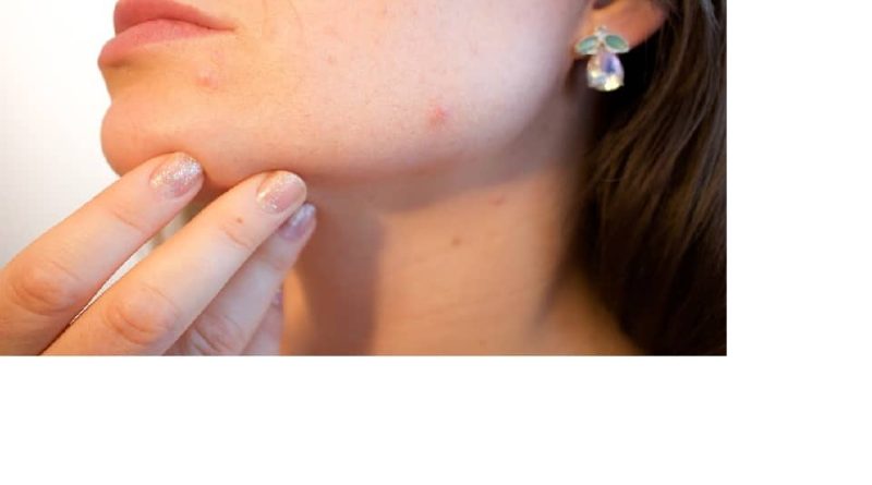 acne 1606765 960 720