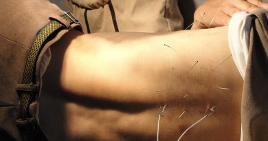 Man getting Acupuncture Treatment on His Back - Advanced Health: The Top 5 Benefits of Acupuncture