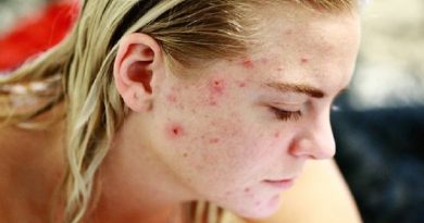 Acne Scars