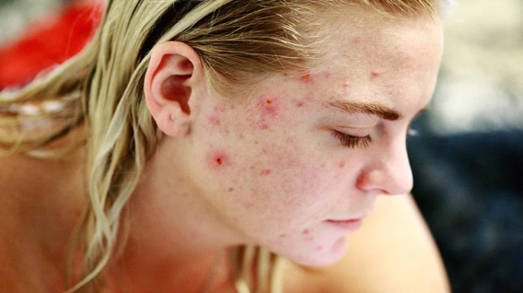 Blonde woman with acne - Common Skin Problems