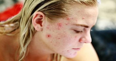 Young Woman with Acne - Cystic Acne