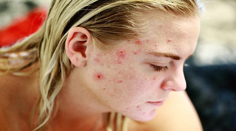Young Woman with Acne - Cystic Acne