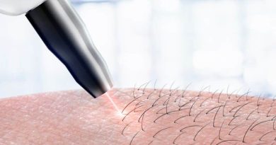 Laser Hair Removal