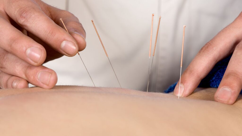Acupuncture physician placing needles in a patients back